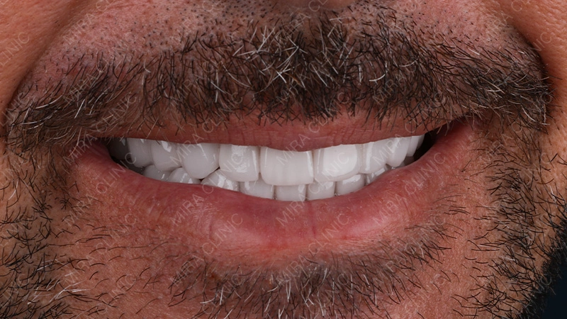 Hollywood smile results